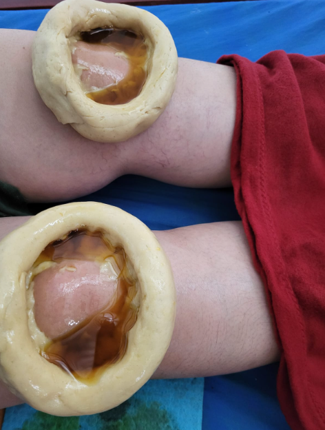 Traditional therapies